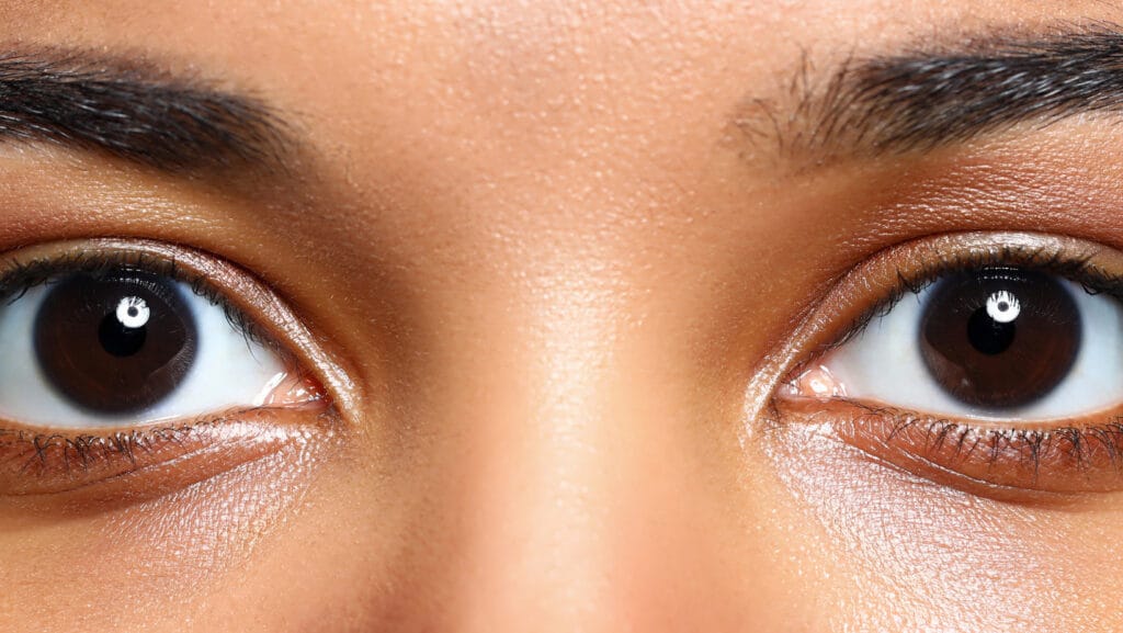 עיגולים שחורים מתחת לעיניים