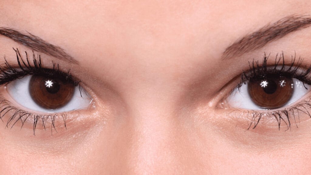 עיגולים שחורים מתחת לעיניים