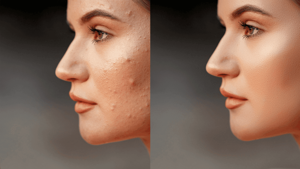 אישה עם חצ'קון לפני ואחרי