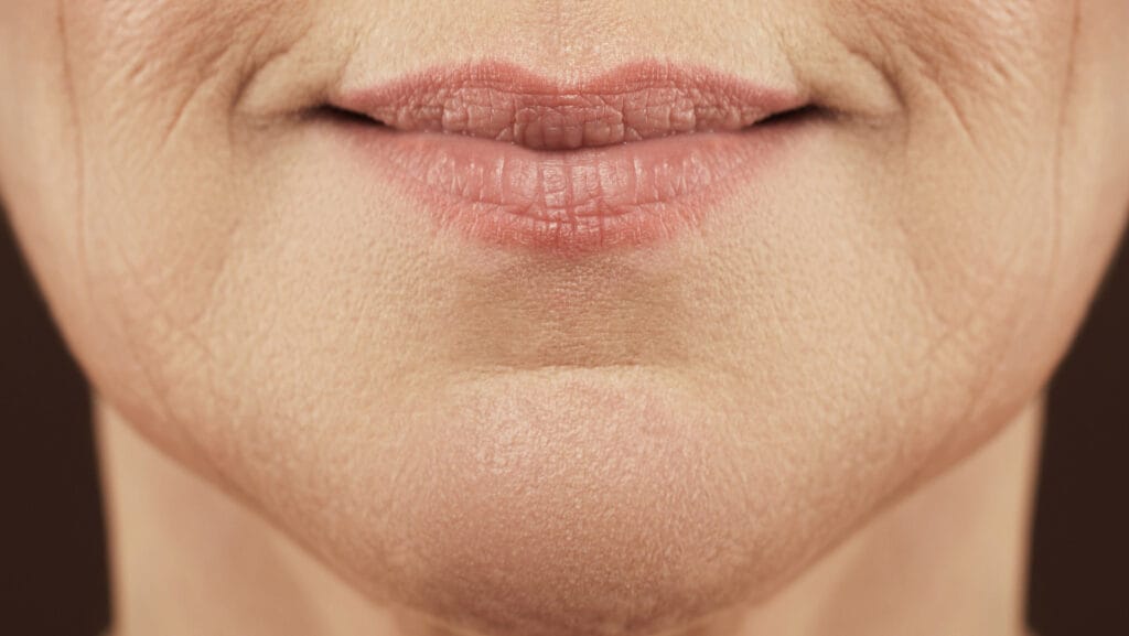תמונה של קמטים בצידי הפה