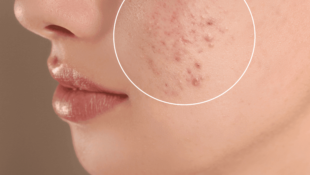 אישה עם עור רגיש ופצעונים