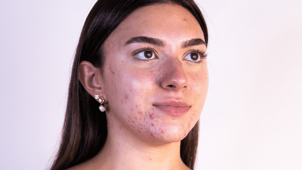 דוגמנית עם אקנה