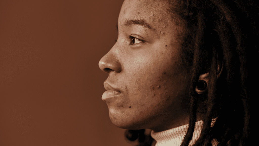 אישה בפרופיל עם אקנה הורמנלי