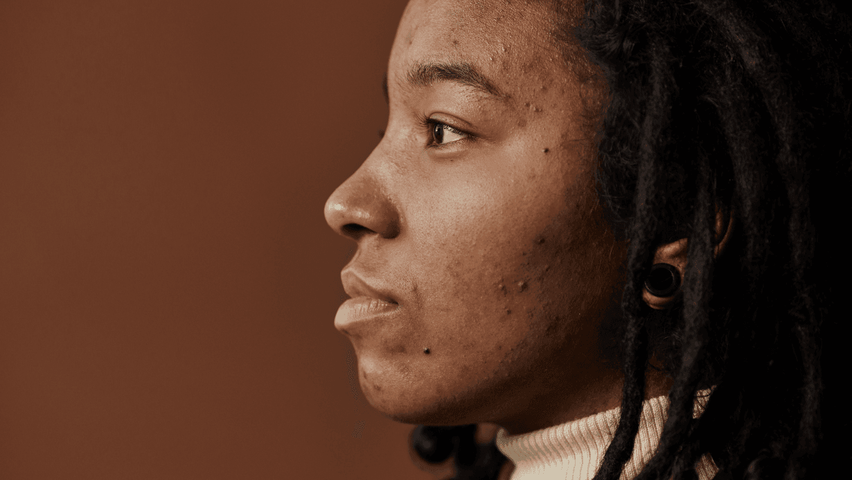 אישה בפרופיל עם אקנה הורמנלי