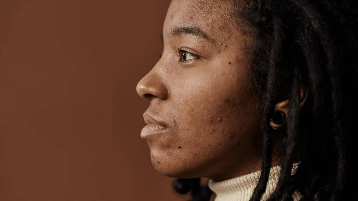 אישה בפרופיל עם אקנה הורמנלי