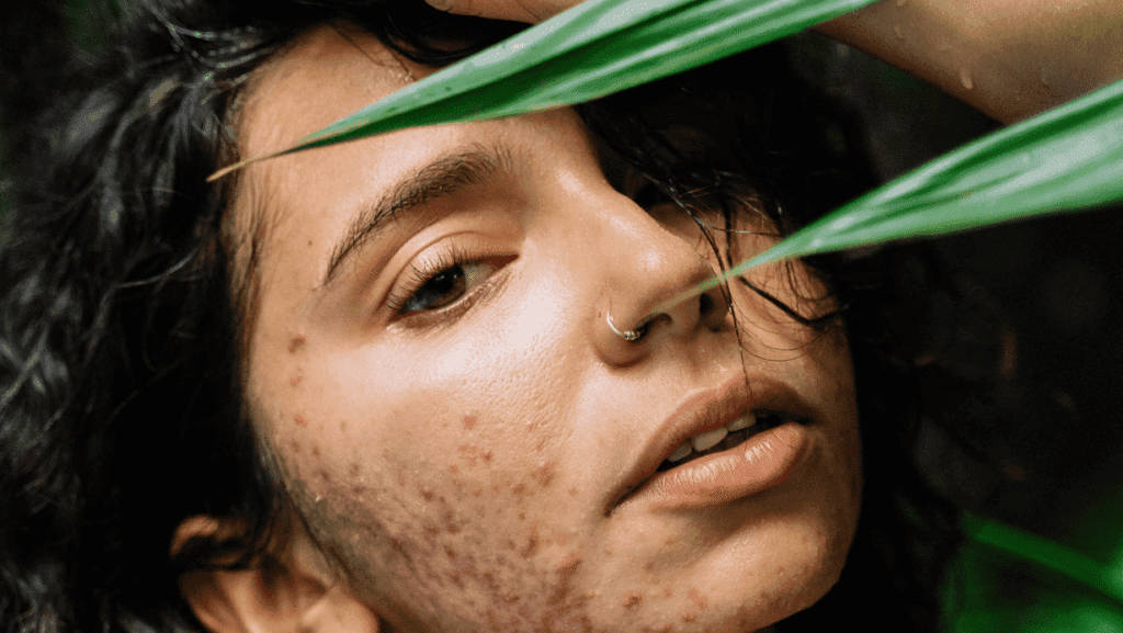 אישה עם אקנה הורמנלי