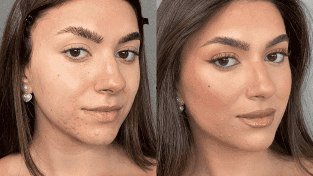 איך להעלים חצ'קון מהר לפני ואחרי