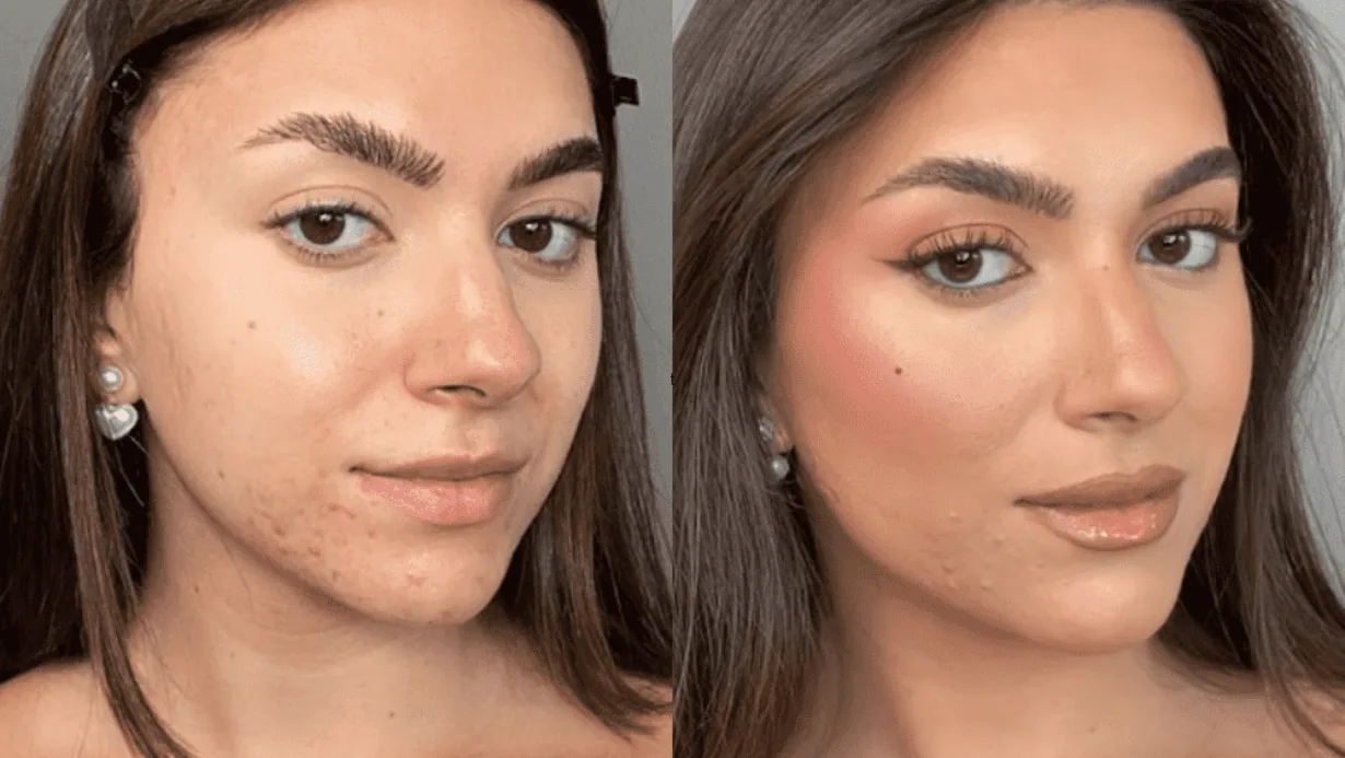 איך להעלים חצ'קון מהר לפני ואחרי