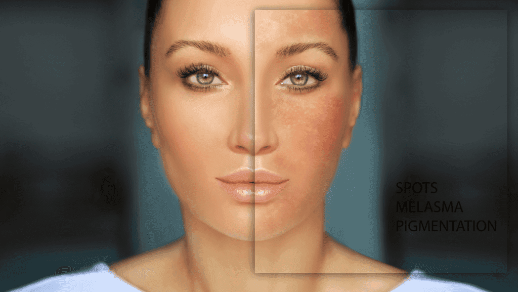 מלמזה בפנים אישה עם מלמזה בפנים